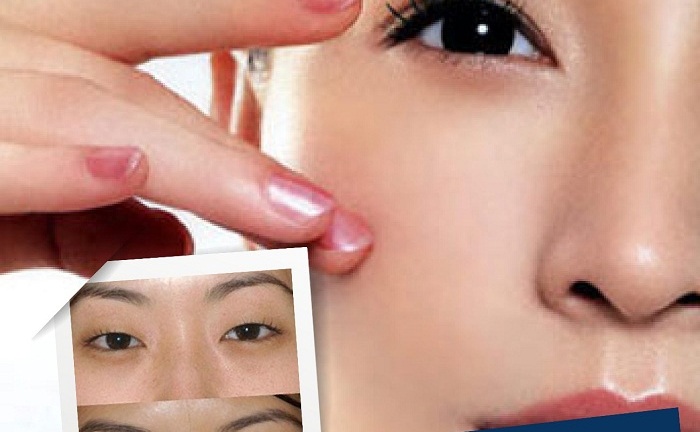 Chữa sụp mí mắt – Cho đôi mắt đẹp tinh anh