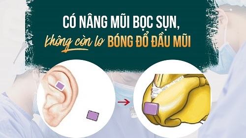 Nâng mũi bọc sụn bao lâu phải làm lại?