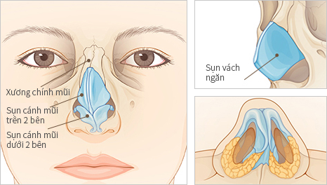 Nên nâng mũi bán cấu trúc hay nâng mũi cấu trúc?