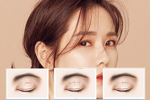 Nhấn mí - Giải pháp cho đôi mắt quyến rũ thu hút mọi ánh nhìn 