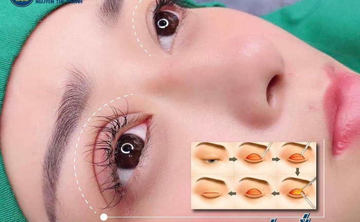 Địa chỉ lấy mỡ thừa mí mắt