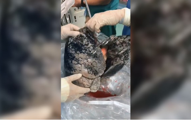 Choáng váng khi thấy lá phổi đen như than của người nghiện thuốc lá 30 năm