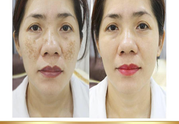 Thẩm mỹ viện quốc tế Bắc Âu điều trị sạch nám sáng da 1 lần