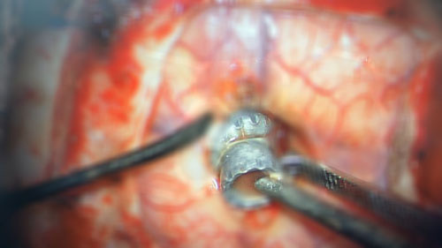 Nghịch dại súng hơi, thanh niên tự bắn mình xuyên mắt vào đầu