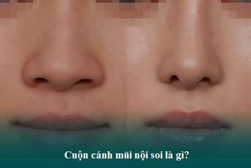 Thu gọn cánh mũi nội soi - Tiểu phẫu nhưng có thật sự an toàn?