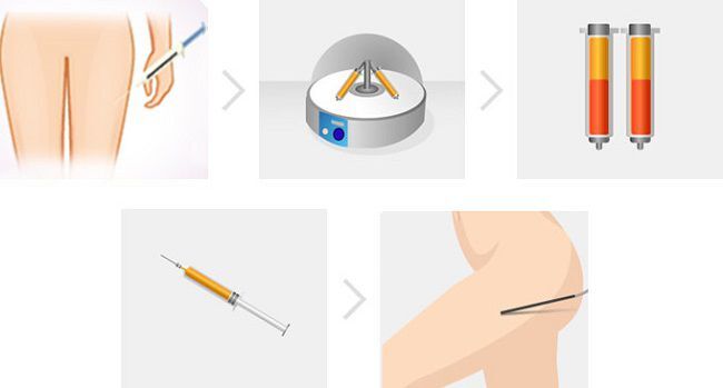 Nâng mông bằng mỡ tự thân có thực sự an toàn không?