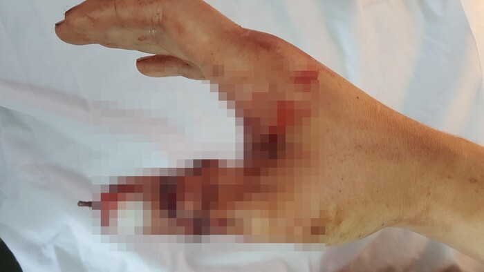 Đang dẹp vỉa hè bị lấn chiếm, thanh tra giao thông bị chém đứt lìa ngón tay