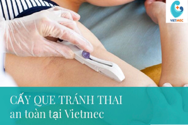 3 vấn đề chị em thường quan tâm về cấy que tránh thai