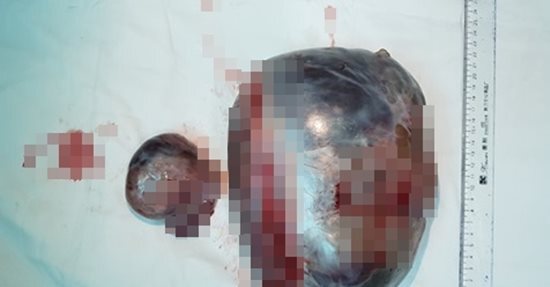 Chủ quan không chữa trị, người phụ nữ 'nuôi' khối u khổng lồ to gấp 10 lần