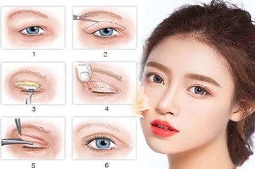 Nguyên nhân và cách khắc phục tình trạng mắt bị sụp mí 