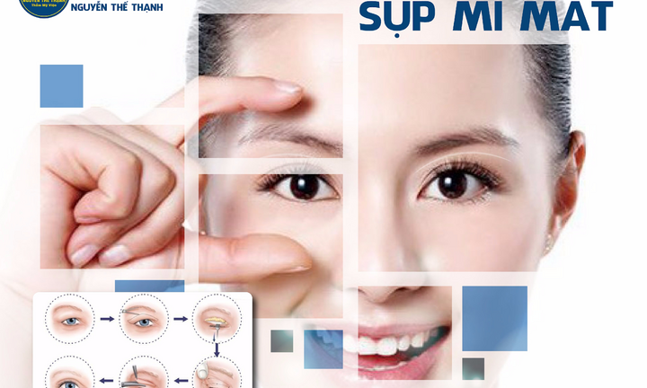Phẫu thuật sụp mí mắt - Lấy lại đôi mắt hút hồn