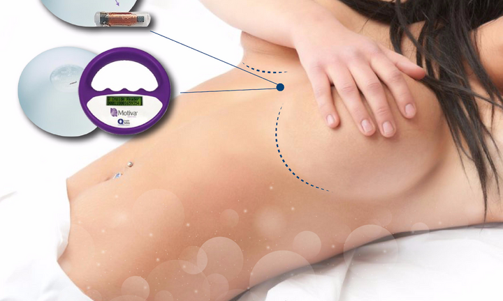 Nâng ngực Nano chip Ergonomix - Giải pháp cho vòng 1 căng tràn 