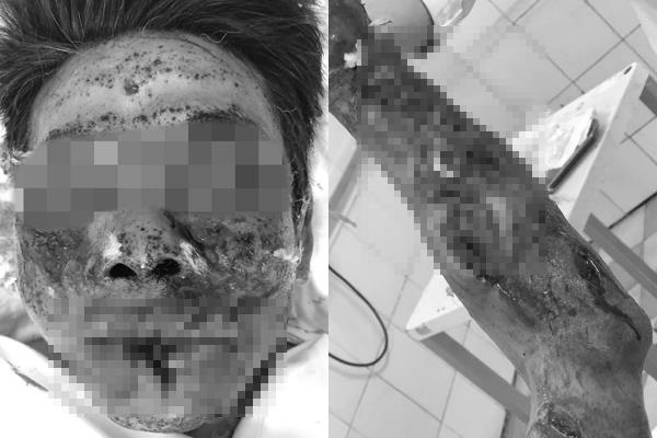 Đốt thử pháo chơi Tết, người đàn ông 44 tuổi nát cả mặt