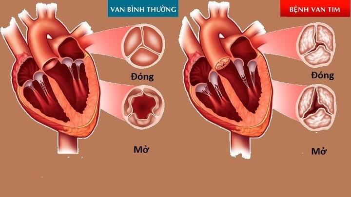 Hẹp hở van tim khó tránh khỏi biến chứng suy tim, loạn nhịp tim