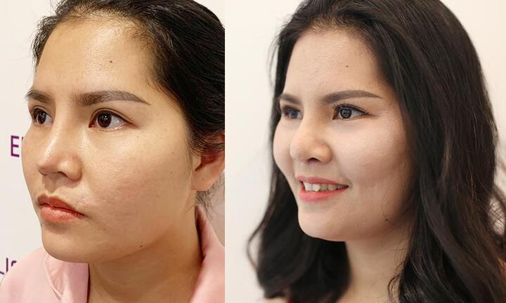 Không tìm hiểu kỹ địa điểm thẩm mỹ, nhiều chị em phải sửa mũi đến lần thứ 5