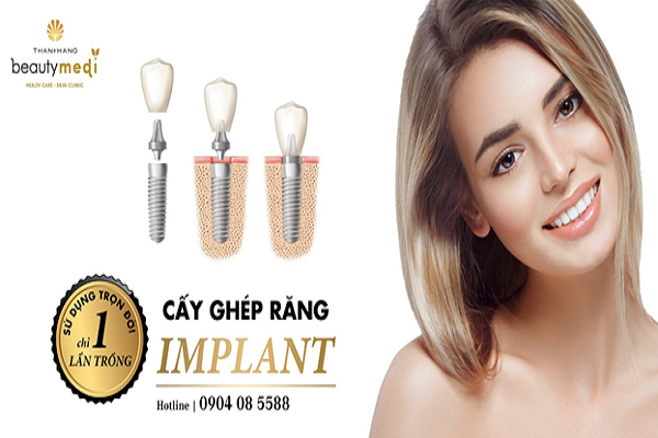 Trồng răng implant sai kỹ thuật – Những biến chứng khôn lường