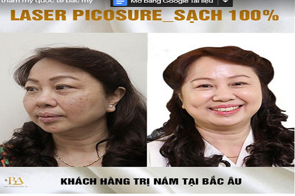 Có nên trị nám bằng Laser không? Lời khuyên của chuyên gia viện thẩm mỹ quốc tế Bắc Mỹ