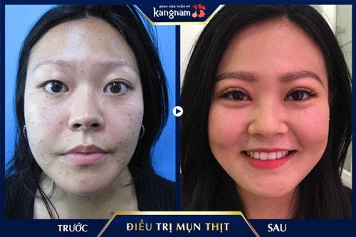 5 lầm tưởng trị mụn thịt ai cũng hay mắc phải khiến mụn mãi không hết!