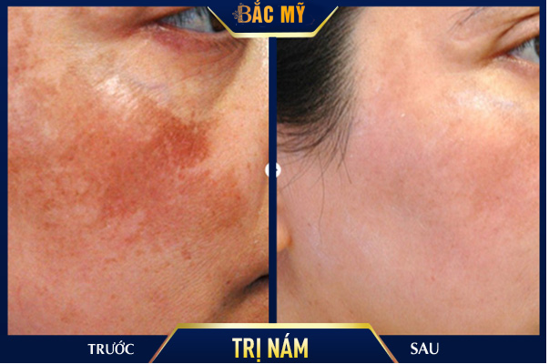 Điều trị nám bằng Laser picosure tại TMV Bắc Mỹ – Công nghệ trị nám tận gốc tiên tiến nhất năm 2020