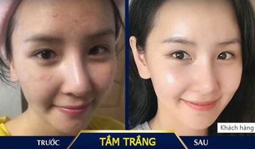 Giải pháp  "thay mới " làn da - Da trắng căng mướt như gái Hàn 
