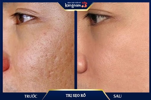 Thoát khỏi nỗi ám ảnh sẹo rỗ bằng liệu trình kép