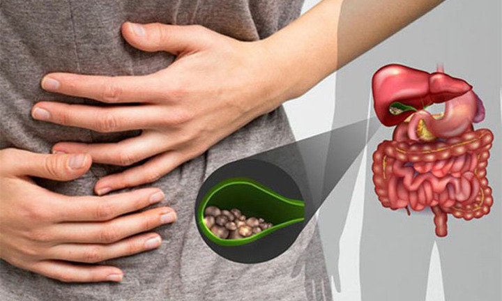 Nhà thuốc tư vấn Thực phẩm chức năng nào giúp bài sỏi mật hiệu quả? 