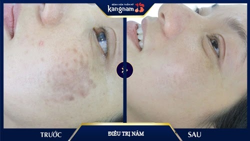 Chị em sau sinh truyền tai nhau bí kip: Sạch 80% nám mà còn trẻ hóa da 