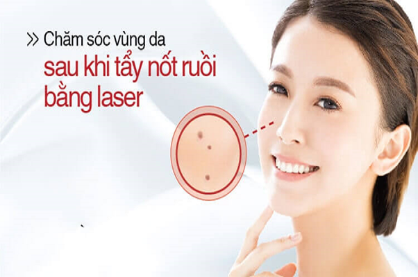 Đừng lơ là việc chăm sóc da sau khi tẩy nốt ruồi bằng Laser