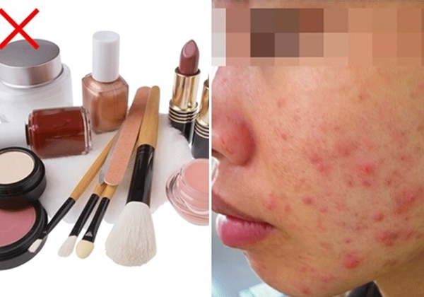 Bị mụn trứng cá nên ăn và không ăn những loại thực phẩm nào