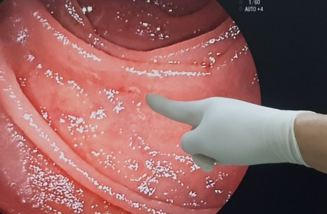 Bệnh nhân mất máu vì trong ruột có tới... 20 con giun mỏ