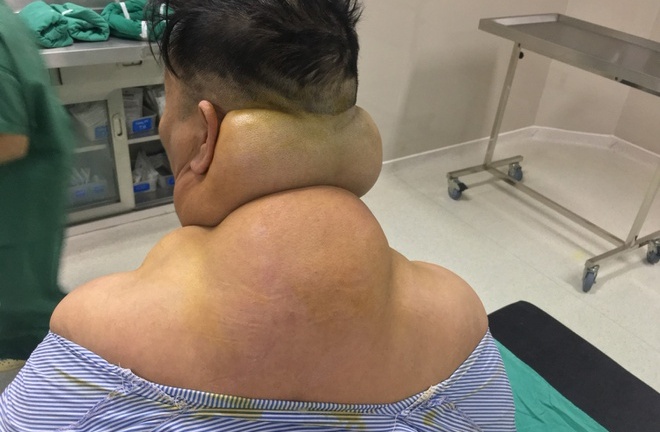 Tin tức đời sống mới nhất ngày 17/5/2020: Người đàn ông bị biến dạng cơ thể do nghiện rượu