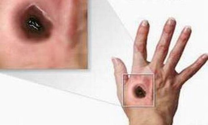 Bệnh than nguy hiểm đang quay trở lại, bác sĩ cảnh báo những triệu chứng đầu tiên