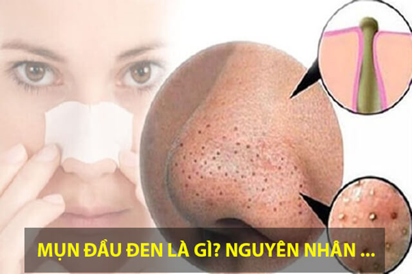 Hiểu rõ về mụn đầu đen và cách chăm sóc hiệu quả