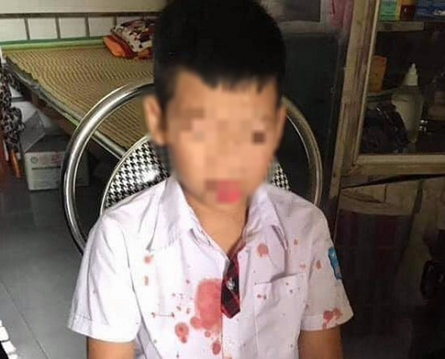 Khởi tố người đàn ông đánh nam sinh lớp 1 phải nhập viện ở Hòa Bình