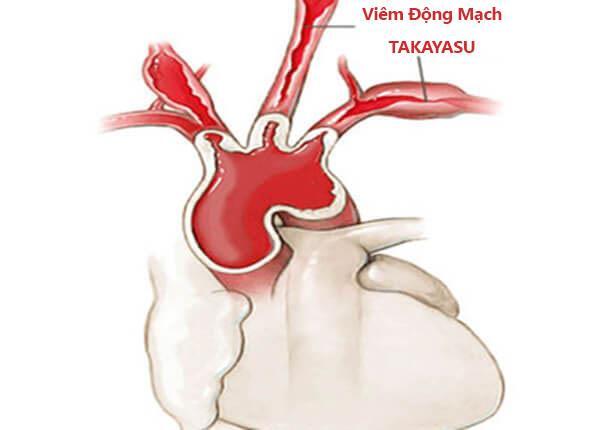 Tìm hiểu triệu chứng và cách điều trị bệnh viêm động mạch Takayasu