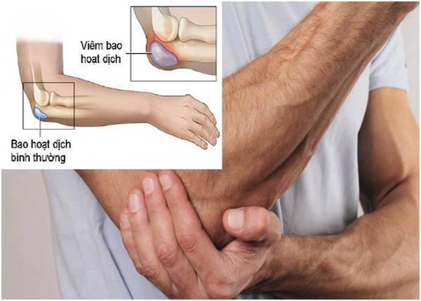Những điều bạn cần lưu ý về bệnh viêm bao hoạt dịch