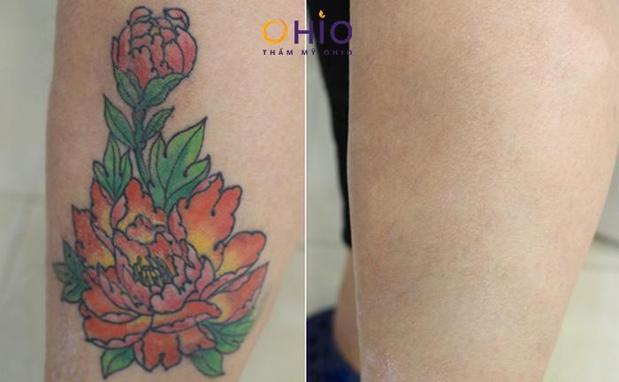 Địa chỉ xóa xăm uy tín ở Hà Nội được cấp phép bởi Sở y tế 
