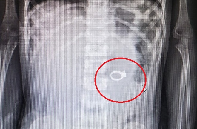 Tin tức đời sống mới nhất ngày 23/9/2020: Gắp chiếc nhẫn trong bụng bé gái