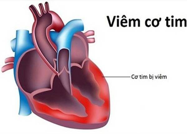 Bác sĩ Dược Sài Gòn hướng dẫn một số xét nghiệm chuẩn đoán viêm cơ tim