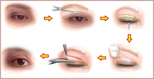 Tại sao đông y có thể phục hồi được cắt mí hỏng?