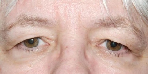 Cách khắc phục bệnh sụp mí mắt ở người cao tuổi bằng đông y