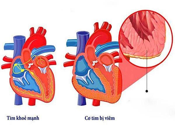 Cùng Bác sĩ Dược Sài Gòn tìm hiểu về viêm cơ tim do virus