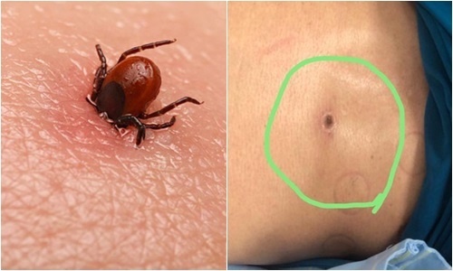 Tin tức đời sống ngày 18/12: Người đàn ông suy đa tạng sau khi bị mò đốt