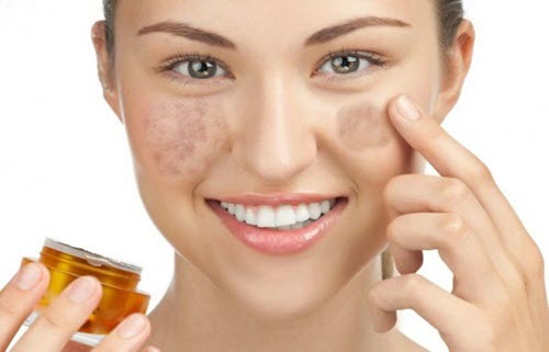 Bạn có thuộc đối tượng dễ bị nám, tàn nhang tấn công?