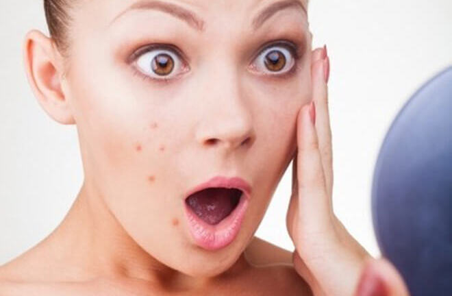 Mách bạn cách loại bỏ mụn hiệu quả theo từng độ tuổi