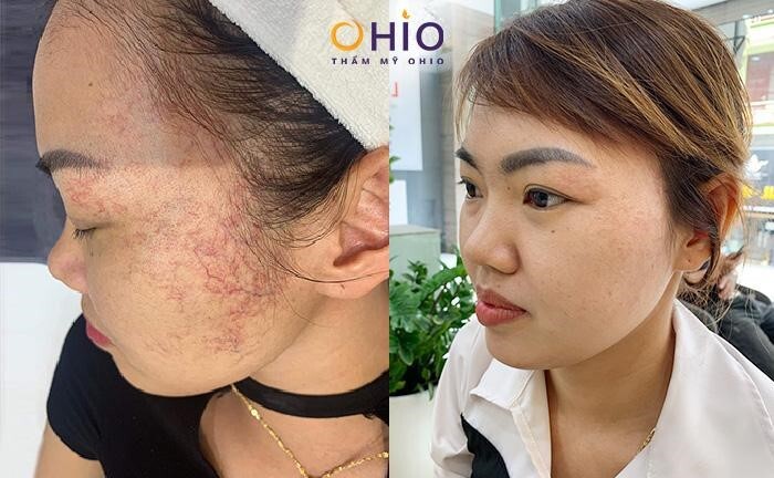 Giãn mao mạch vùng mặt có nguy hiểm không & giải pháp điều trị?