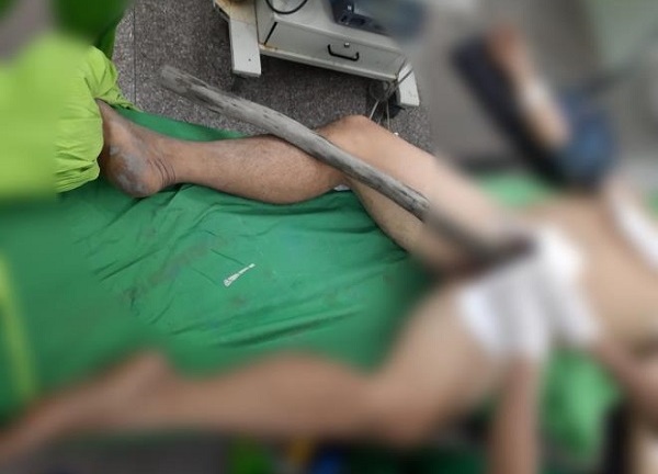 Cần Thơ: Cứu sống người đàn ông bị cây gỗ 1,5m đâm xuyên người