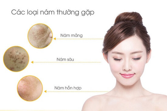 Tránh xa 5 sai lầm sau nếu không muốn việc trị nám trở nên tồi tệ hơn