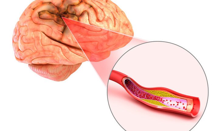 Đột quỵ não và vai trò của chụp cộng hưởng từ (MRI) trong tầm soát đột quỵ 