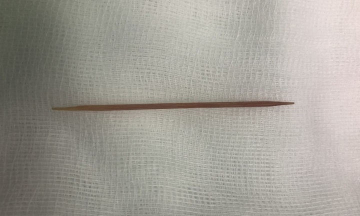 Tin tức đời sống ngày 21/2: Thủng dạ dày vì nằm võng nuốt phải tăm tre